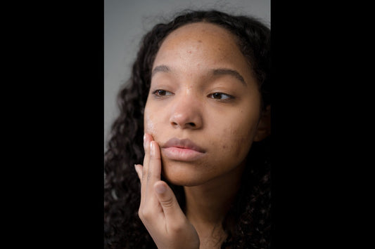 Hydration vs. Moisture: Why "Drying Out" Your Acne Is Making It Worse